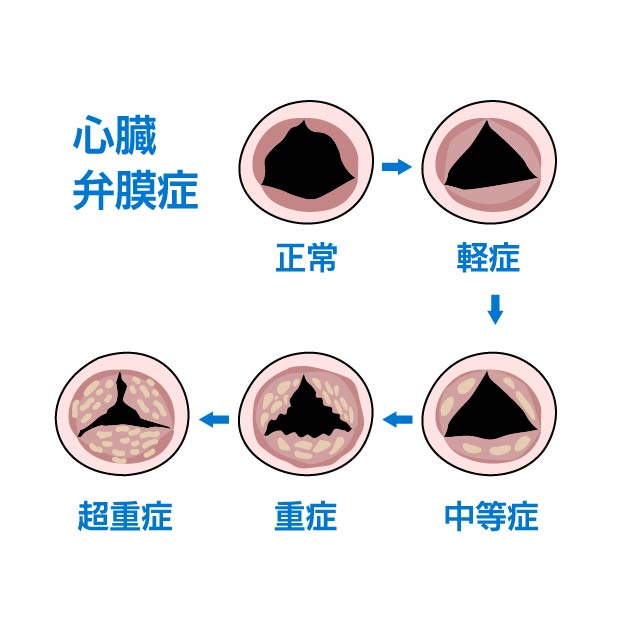 心臓弁膜症