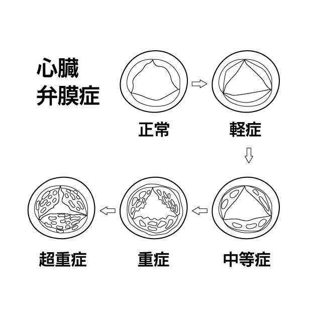 心臓弁膜症の無料モノクロイラスト