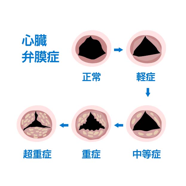 心臓弁膜症の無料線なしイラスト